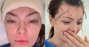 FOTO Ella Dvornik novim operacijama šokirala! Uznemirujuće snimke oporavka nikog ne ostavljaju ravnodušnim